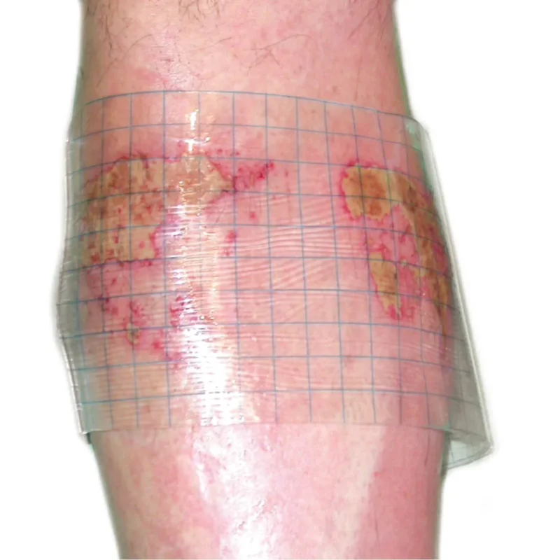 HydroTac transparent Gelverband ohne Rand - hydroaktiv für trockene Wunden - Med-Praxisbedarf